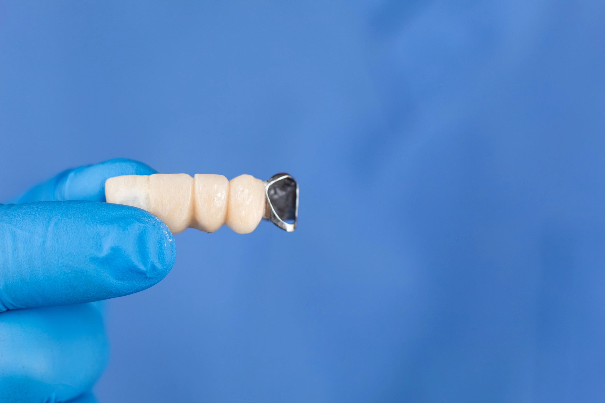 Maryland bridge — minimal prep dental bridge Sydney